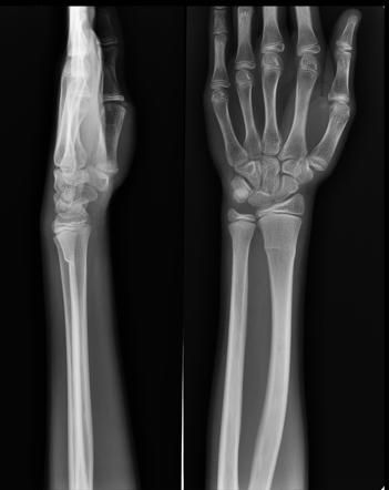 Torus Fracture - यात हाड तुटत नाही पण हाडाचा आकार बदलल्याने वेदना होतात. 