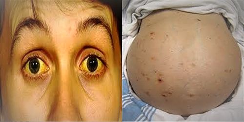 कावीळ आणि हेपॅटायटिसमध्ये काय फरक आहे? जाणून घ्या या रोगाची लक्षणे आणि उपाय!!