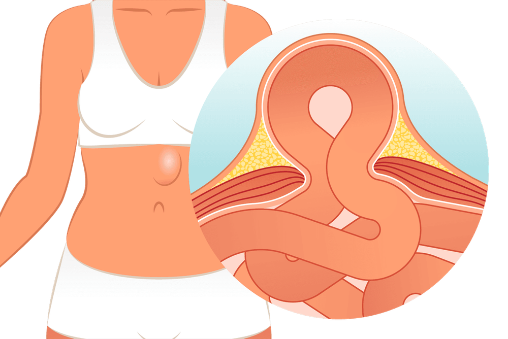 हर्नियाचे प्रकार, लक्षणं आणि उपचार पटकन वाचून घ्या आणि तो होऊ नये म्हणून काय काळजी घ्यावी हे ही वाचाच..