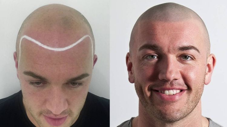 9)डोक्यावरील कातडी म्हणजेच स्काल्प