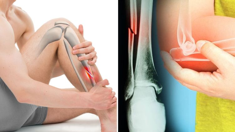 फ्रॅक्चरचे १५ प्रकार, तुमचं यातल्या कुठल्या प्रकारचं फ्रॅक्चर झालं होतं??