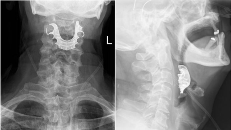 या माणसाचे दात त्याच्याच घशात कसे अडकले ? गंमत म्हणजे भारतात अशा घटना घडू नयेत म्हणून नियम आहे !!