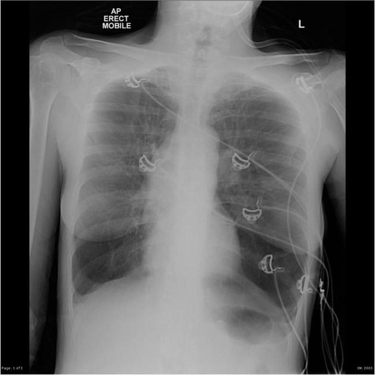 ९. त्याला अल्फा-1 अँटीट्रिपसीन डेफिसीयन्सी नावाचा दुर्मिळ आजार होता. हा त्याचा आजार आनुवंशिक होता.