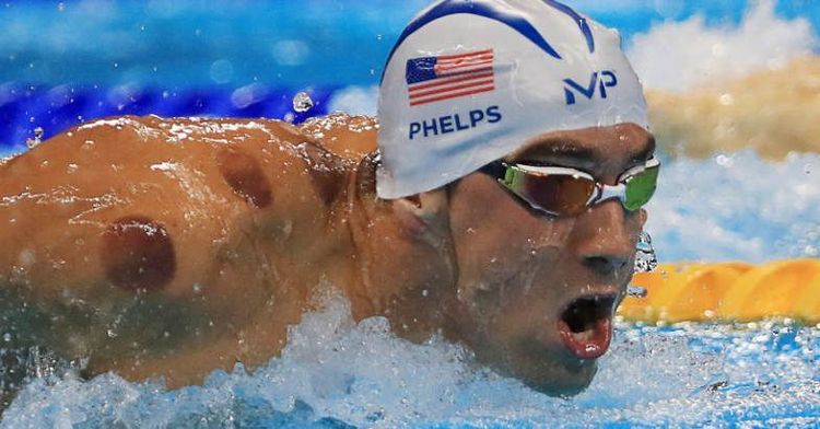 ऑलिंपिक २०१६ : फेल्प्स आणि इतर खेळाडूंच्या अंगावरच्या जांभळ्या डागांचं रहस्य उलगडलं..