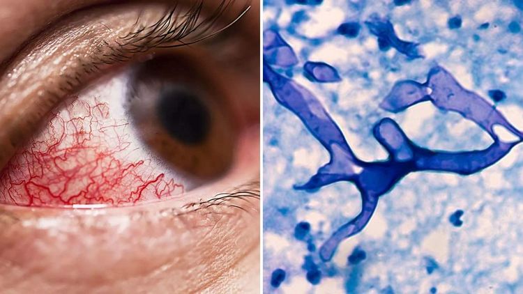 म्युकरमायकोसिस किंवा ब्लॅक फंगस काय आहे? याचा धोका नेमका कधी आणि कुणाला होतो?