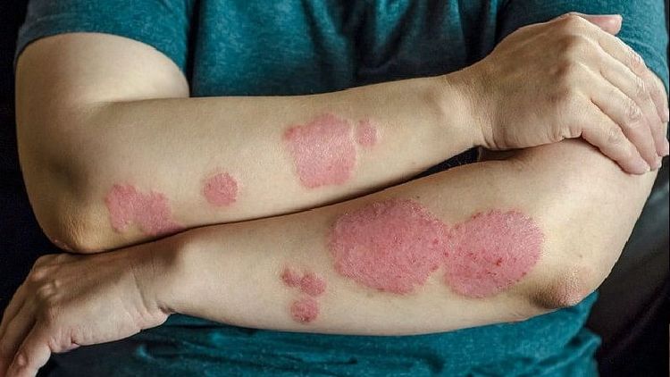 सोरायसिस