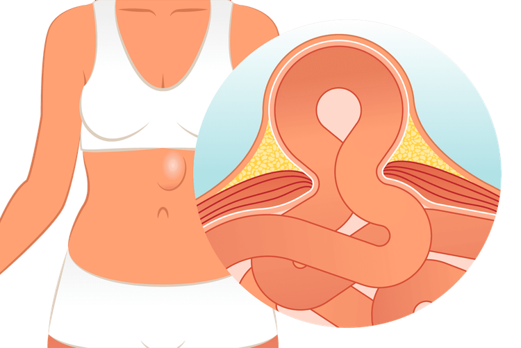 हर्नियाचे प्रकार, लक्षणं आणि उपचार पटकन वाचून घ्या आणि तो होऊ नये म्हणून काय काळजी घ्यावी हे ही वाचाच..