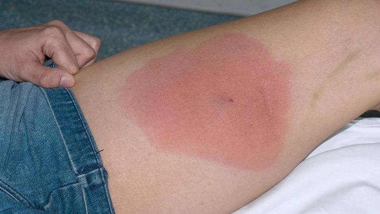 गळूचे प्रकार कोणते?