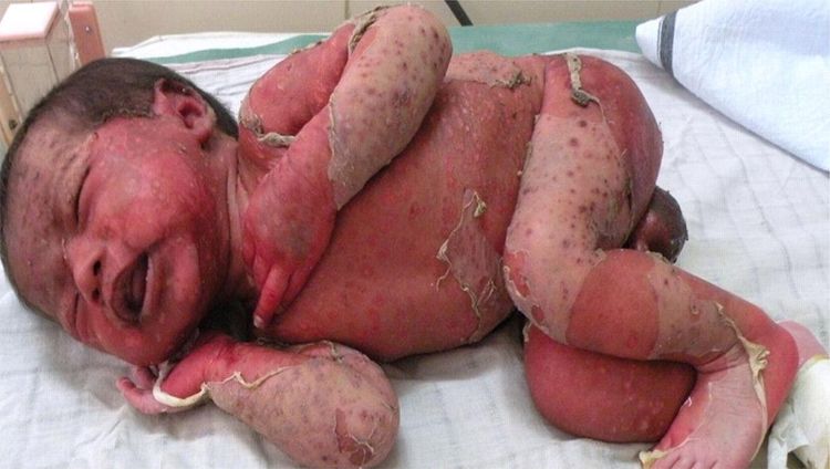 स्टॅफिलोकोकल स्केल्ड स्किन सिंड्रोम