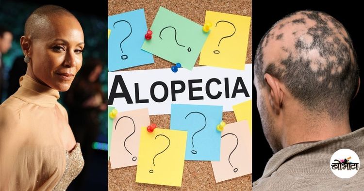 केसगळती, ॲलोपेशिया आणि ऑस्कर २०२२ मधली गाजलेली थप्पड!! हा आजार नेमका काय आहे, का होतो आणि त्याचे परिणाम काय?