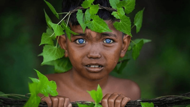 या सुंदर धगधगत्या निळ्या डोळ्यांमागे लपला आहे एक जनुकिय आजार !