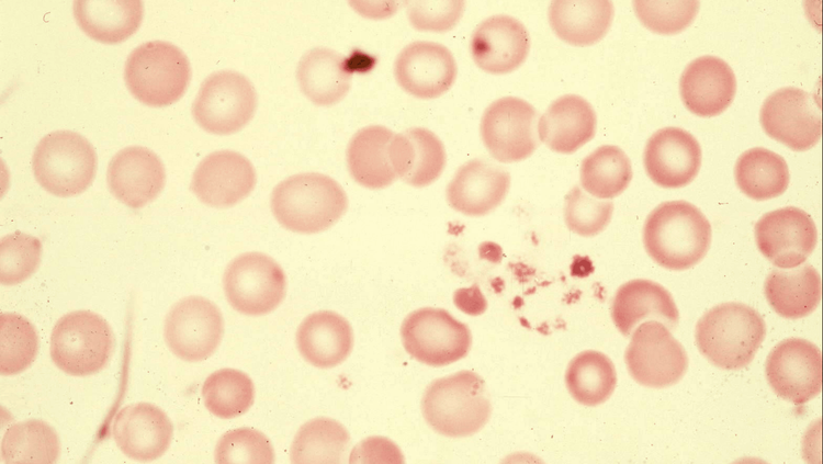 तीव्र ताप ? मळमळ? अंगदुखी ? लवकरात लवकर डॉक्टर कडे जाऊन रक्त तपासणी करून घेणे 