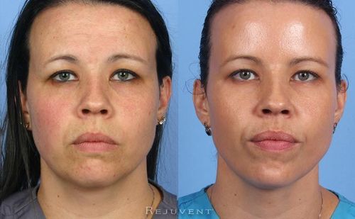 ५. केमिकल पील