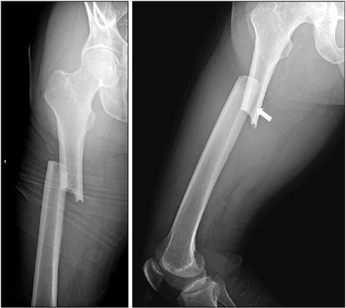Oblique Fracture - हाडाच्या अक्षावर झालेले फ्रॅक्चर.