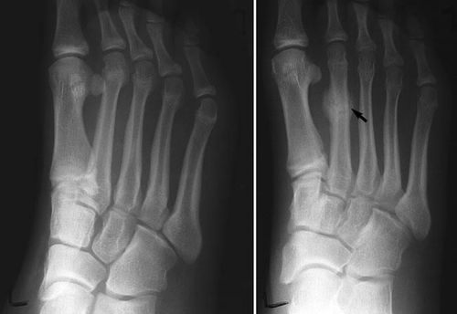 Stress Fracture - विशिष्ट भागावर नेहमी दबाव किंवा ताण पडून तुटणे. हे फ्रॅक्चर खेळाडूंमध्ये जास्त आढळून येते. 
