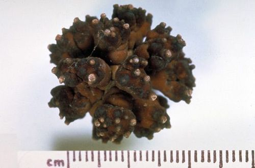 किडनी स्टोनचे प्रकार