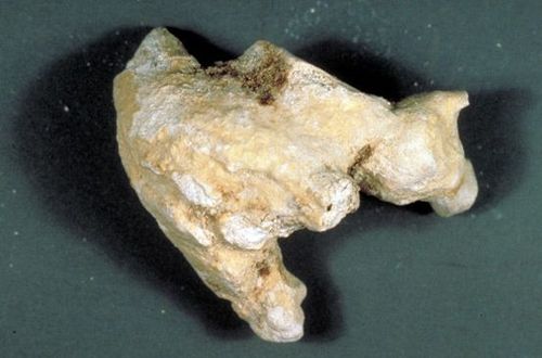 स्ट्रुव्हाइट स्टोन्स